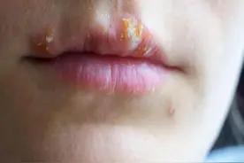 频繁上火有内热 是体内阴液不足了 一招帮你补足五脏之阴 远离上火图片