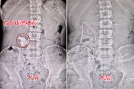 男子“狂炫”碳酸饮料及辛辣食物，结石“找上门”图片