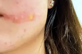 我的天啊！女子被放屁虫 100 度毒屁烫伤，大家要小心啊图片