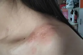 这种剧痛叫“带状疱疹”，怎么治好得快？这个方法可以帮你！图片