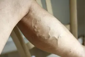 血栓不是突然形成的，形成时通常会有4个异常，常常都被忽视了图片