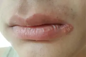 嘴角总是反复起疱和裂口是怎么回事？中医告诉你答案图片