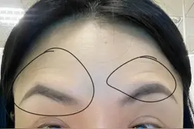 三个部位是肉毒毒素注射翻车的重灾区，打肉毒素之前一定要注意！图片