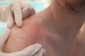 男性私密部位瘙痒，如何应对？皮肤科医生：这些止痒方法要牢记！图片