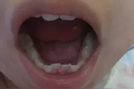 好多小孩乳牙没掉，新牙就长出来了，怎么办？？？图片
