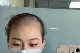 发际线一直上移怎么办？过来人教你防脱育发！60天养出茂密绒毛！图片