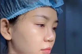 河北姑娘天生蒜头鼻、鼻翼肥厚，整形后即刻后照镜子：不敢信！图片