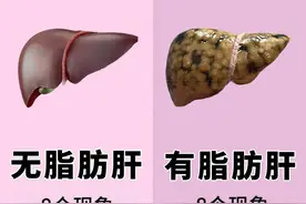 自测一下有没有脂肪肝，一分钟快速了解图片