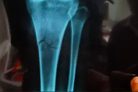骨折三个星期复查，骨折线还是那么清晰图片