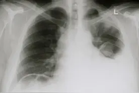 胸腔积水会导致死亡吗图片