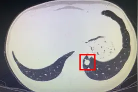 女子肺部长出“玻璃弹珠”，原来是肺动脉抄近路导致罕见结节图片