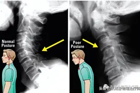 颈椎病引发症状，该怎么办？这个结构别忽视图片