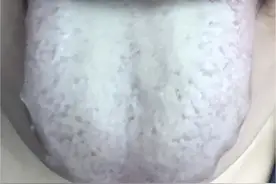 夏季湿重，祛湿猛将二陈丸，参苓白术散，龙胆泻肝丸到底该怎么选图片