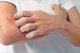 银屑病不管多早期，治疗完了都会再复发吗？医生给出解释图片
