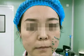 46岁女士去北京做拉皮，术后公开手术经历，原来网友都是骗人的！图片