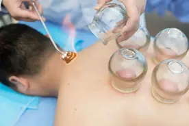 拔火罐的好处和坏处有哪些？拔火罐后皮肤黑紫原因有哪些？图片