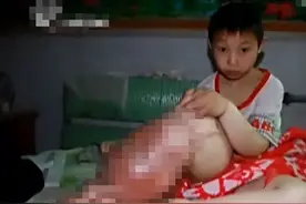河南10岁“象腿”男孩，多位名医束手无策，最后被整容医生治好！图片