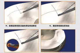 【锐博问答】半月板缝合术后再次核磁仍然显示撕裂是怎么回事？图片