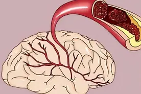 5种改善脑供血不足的中成药，预防脑梗、脑出血！赶紧收藏！图片