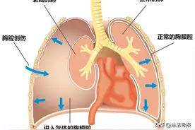 “爆肺”上热搜！“气胸”到底是啥病？图片