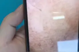 女子为护肤1个月不洗脸致满脸结痂图片
