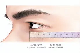 眼球突出是不是病？图片