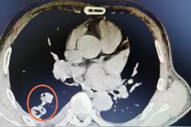 当心寄生虫！吃了几次野生黄鳝，爹爹肺上长俩包图片