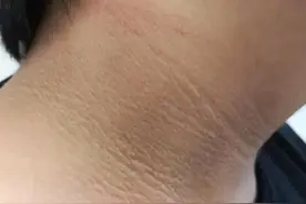 脖子上黑黑的，可不是灰，可能是这种病！图片