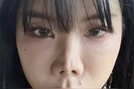 30岁女士来京进行第4次鼻修复，术后20多天感叹，这次上岸了！图片