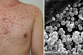 脂溢性皮炎会断根吗？ 需擦保湿乳液吗？图片