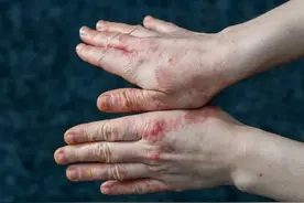 湿疹手胳膊腿私处瘙痒难忍，反复发作抓破渗血，一个方法立刻止痒图片