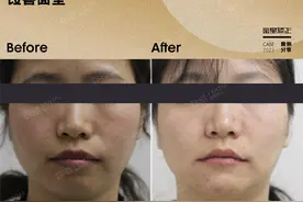 拔掉四颗门牙做正畸，既避免后续种植费用，又能解除嘴突没下巴！图片