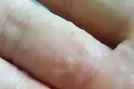 夏季手上长水疱？可能是汗疱疹！附联合用药方案图片