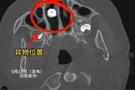 7岁男孩鼻腔藏锈螺丝两年，家长需警惕儿童安全隐患图片