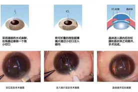 全飞秒、icl晶体植入术，哪种手术方式好？图片