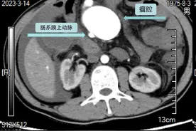 体内藏着一颗“特殊炸弹” 苏州医生将他从死亡边缘救了回来图片