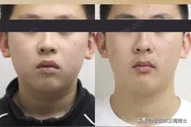 小孩子戴功能矫治器导下巴，其实是智商税？图片