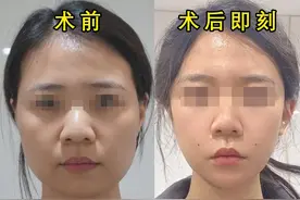求美者双层精雕面部吸脂、面部馒化修复案例合集（2）图片