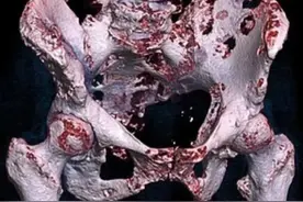 癌症骨转移：并不等同于生命终点的来临图片