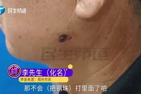 男子意外发现自己具有“超能力”，医生：“从业20年第一次见！他掏出一个吸铁石一放脸上就吸住了！”图片