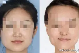 长期单侧咀嚼，会发生什么？图片