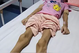 15岁少女为爱减肥只剩48斤，连续50天只喝水，妈妈含泪拔她氧气管图片