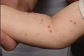 闹大了！合肥一男孩水上乐园玩水，感染传染性软疣，评论炸锅了！图片