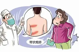 带状疱疹火辣辣地疼，梅花针+火罐，通常三五次就见效图片