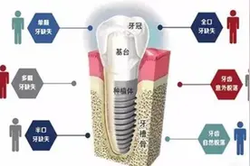 种植牙教你三点，帮你拿到高性价比的种植方案图片