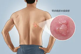 有一种剧痛叫“带状疱疹”，专家：50岁后尤其要当心，积极预防图片