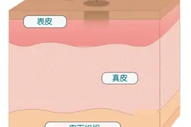 被蚊子叮了为什么会留下黑印？这些方法能去除→图片