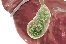 治疗胆结石，不止有手术，你还有更好的选择图片