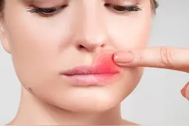 嘴唇起泡是上火？可能是这种病毒在作怪，感染后终生携带！图片