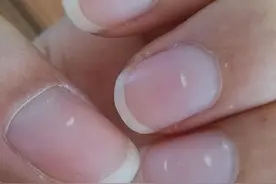 体内有疾，指甲先知？提醒：出现以下五种情况，一定要去医院图片